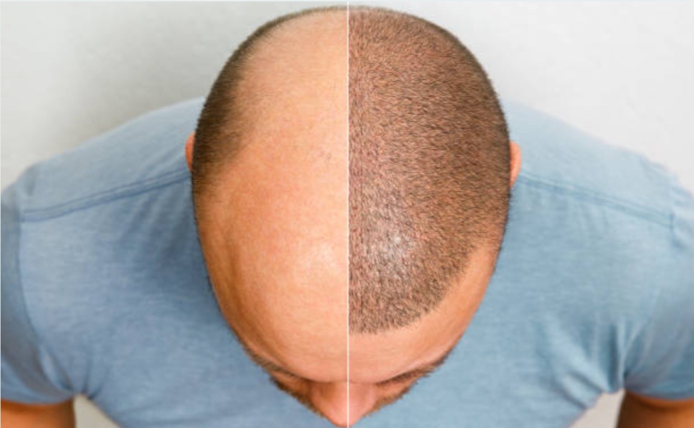 injerto capilar Ciudad Real